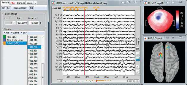 Prüfung der Epilepsieaufzeichnungen mit Markierung der epileptischen Spitzen