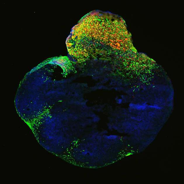 Neoplastisches Gehirn-Organoid mit GFP-positiven Tumorregionen (grün), das eine Glioblastom-ähnliche Zellularität aufweist.