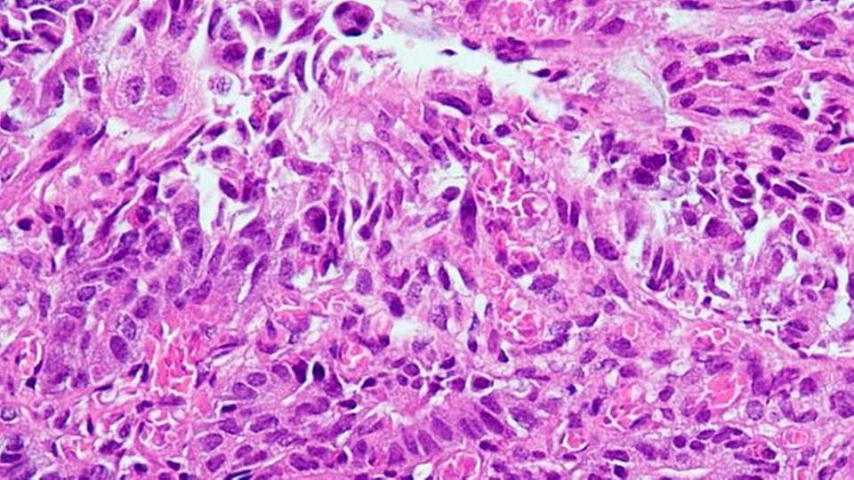 Künstliche Intelligenz kann medizinische Bilder wie diese histopathologischen Aufnahmen zur Krebsdiagnostik bereits gut analysieren. Sobald allerdings Textinformationen integriert werden, schneidet sie bei der Genauigkeit deutlich schlechter ab.
