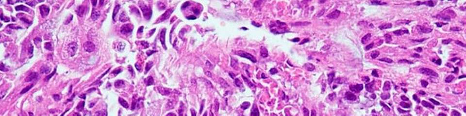 Künstliche Intelligenz kann medizinische Bilder wie diese histopathologischen Aufnahmen zur Krebsdiagnostik bereits gut analysieren. Sobald allerdings Textinformationen integriert werden, schneidet sie bei der Genauigkeit deutlich schlechter ab.